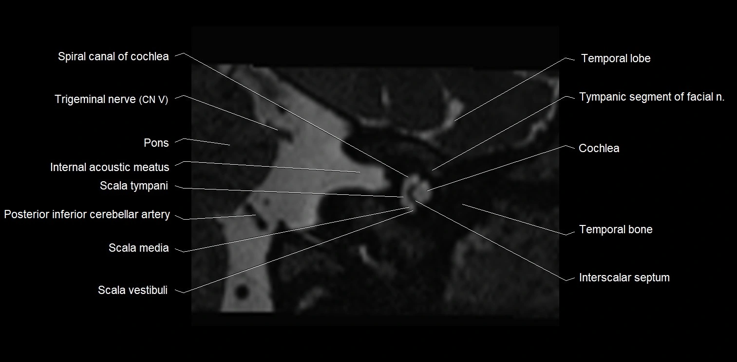 Internal auditory meatus (IAM) axial cross sectional anatomy image 5.webp